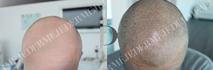 alopecia areata, universale, calvizie e tricopigementazine